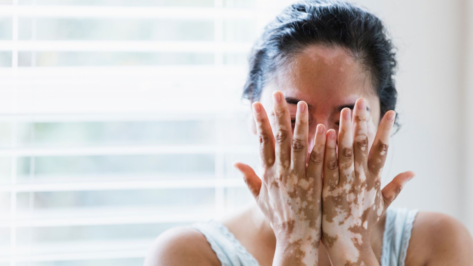 Desvendando o Vitiligo: Das Causas aos Cuidados Essenciais