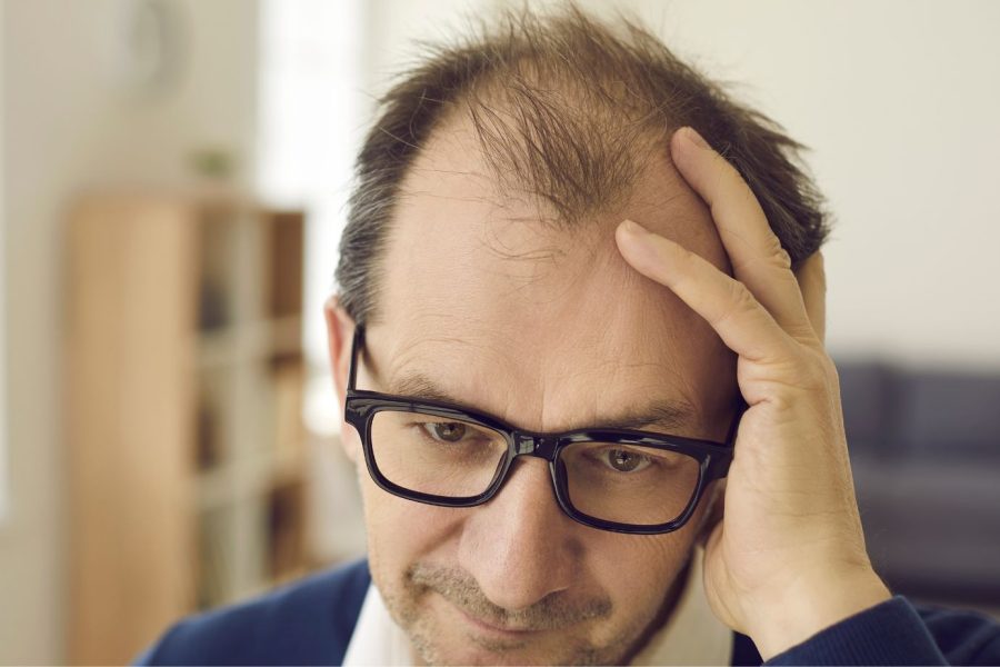 Calvície: Diga Adeus à Queda de Cabelo!