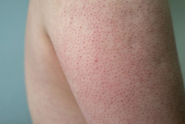 Ceratose Pilar: O Que É e Como Tratar de Forma Eficaz