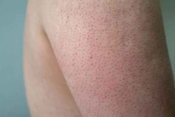 Ceratose Pilar: O Que É e Como Tratar de Forma Eficaz