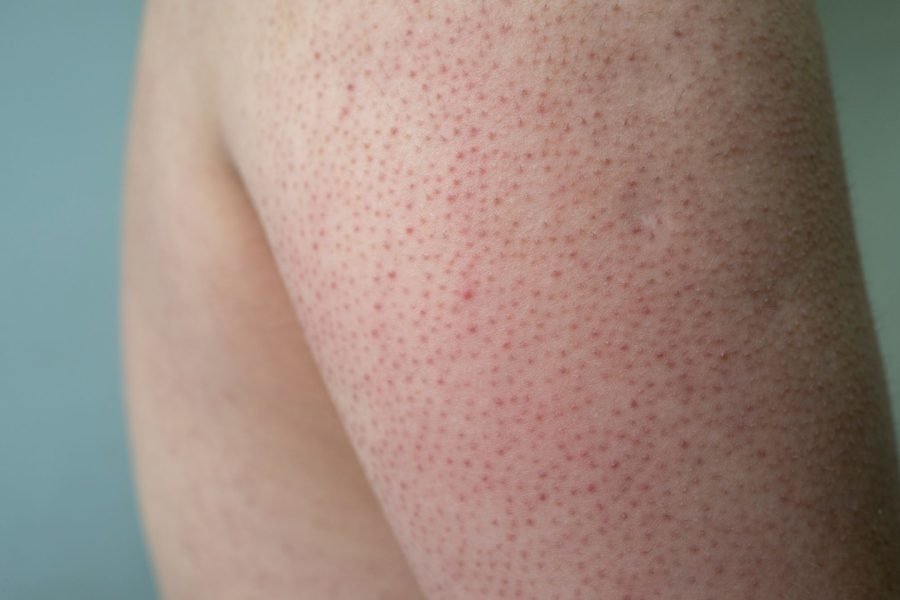 Ceratose Pilar: O Que É e Como Tratar de Forma Eficaz