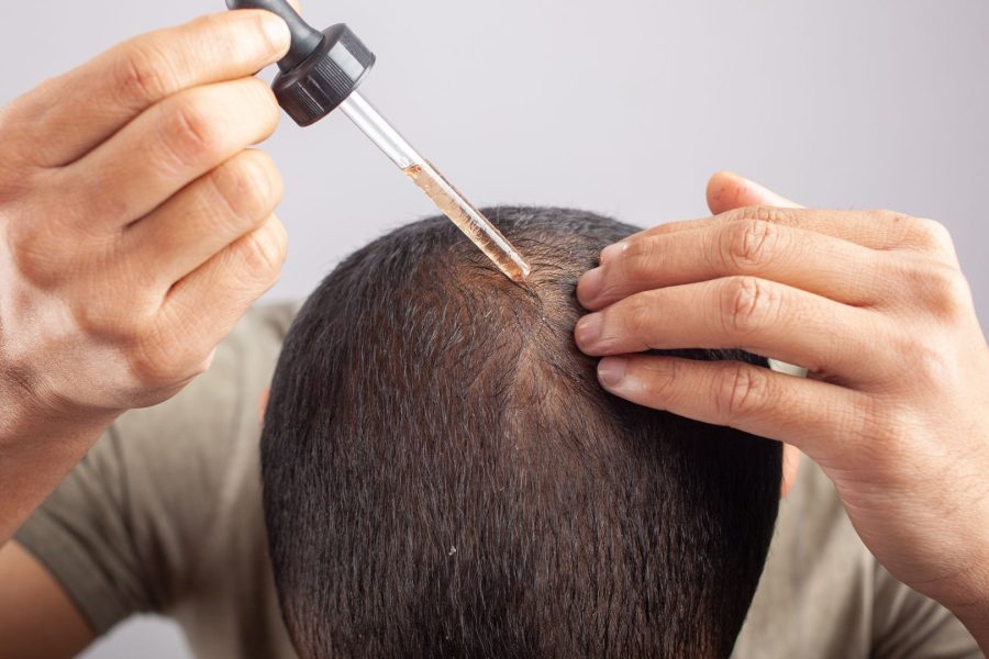 Minoxidil, qual melhor porcentagem?