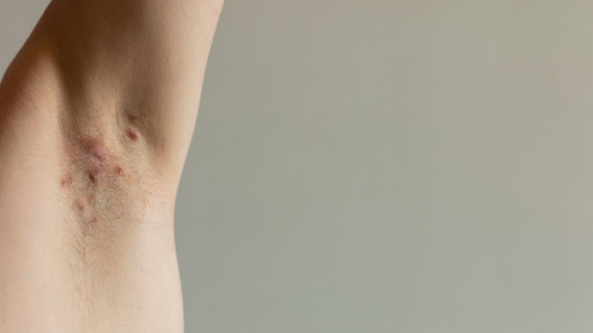 Hidradenite Supurativa: O Que É, Sintomas, Tratamentos e Como Controlar a Doença de Forma Eficaz